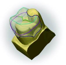 Cerec Crown Tooth Model