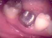 Traditional tooth crown preparation