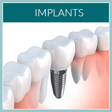 Implants