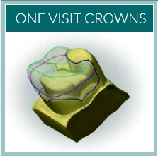 One Visit Crowns